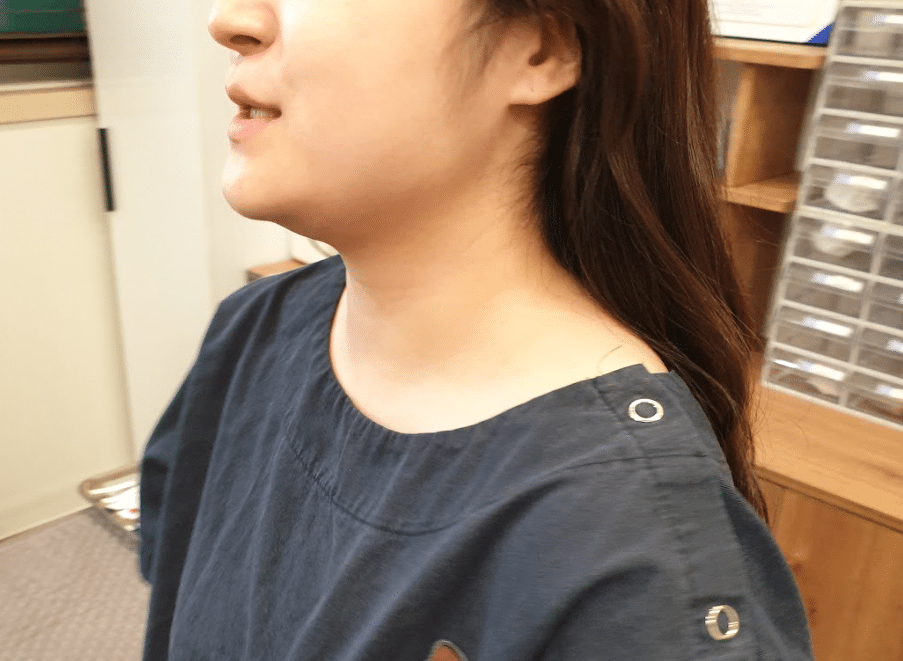 설인신경통 원인1